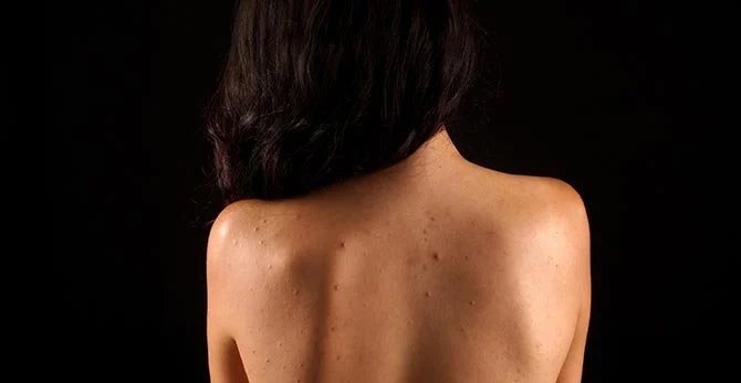 Pelle_acneica_schiena