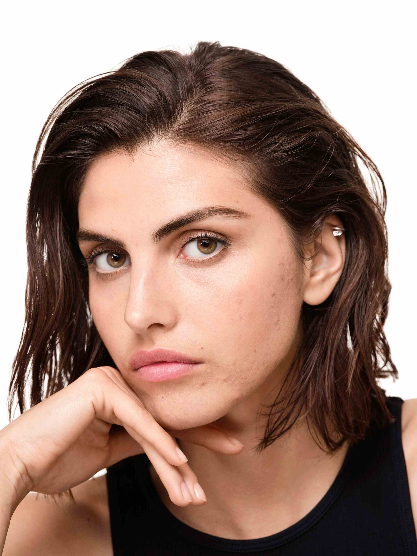 pelle a tendenza acneica